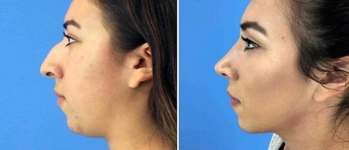 Rhinoplasty Before & After Gallery - Patient 38564709 - Image 1