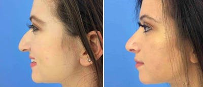 Rhinoplasty Before & After Gallery - Patient 38564710 - Image 1