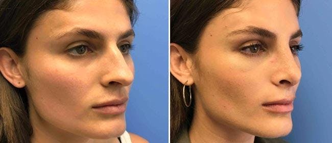 Rhinoplasty Before & After Gallery - Patient 38564711 - Image 1