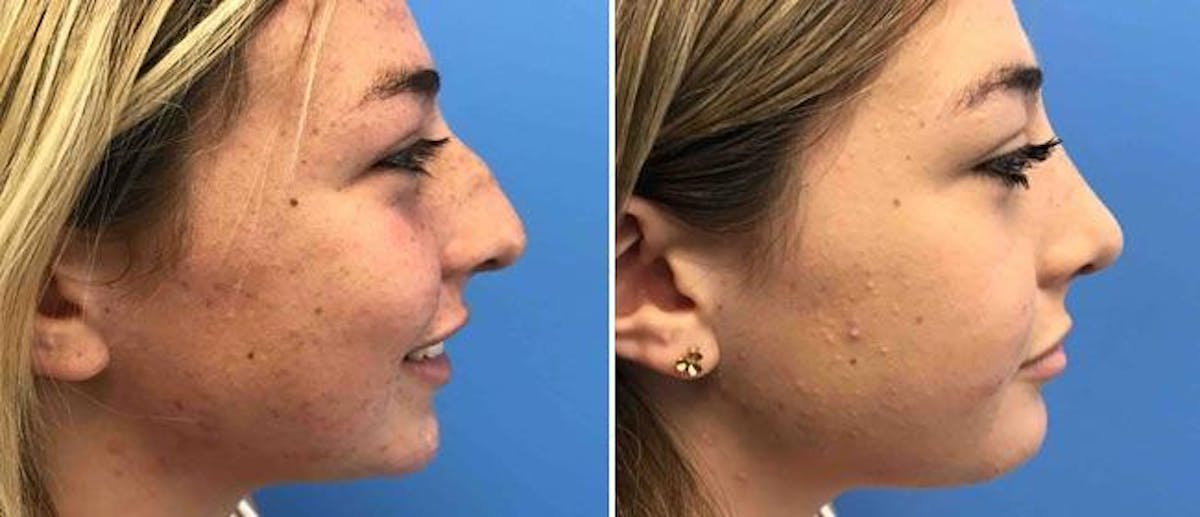Rhinoplasty Before & After Gallery - Patient 38564712 - Image 1