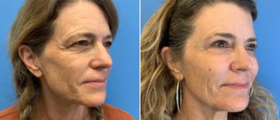 Brow Lift Before & After Gallery - Patient 38564728 - Image 1