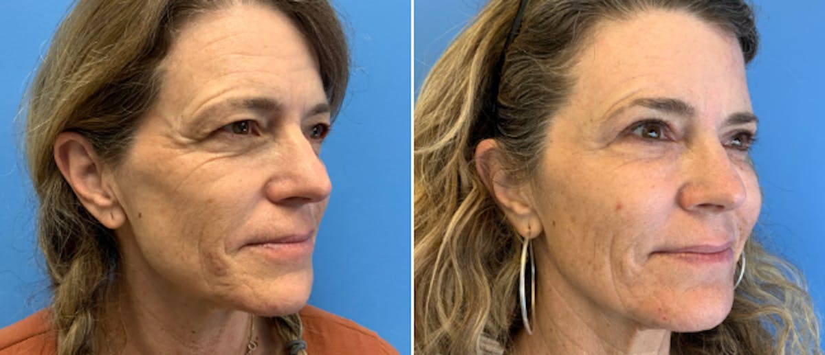 Brow and Forehead Lift Before & After Gallery - Patient 38564728 - Image 1