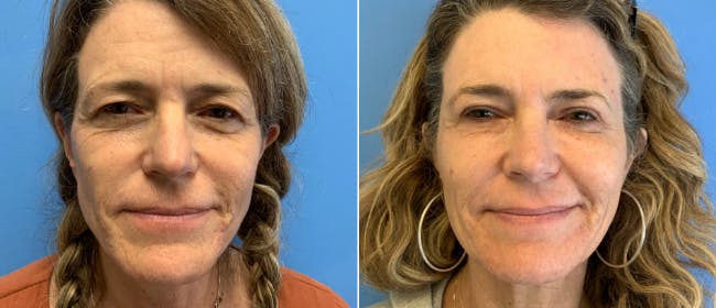 Brow and Forehead Lift Before & After Gallery - Patient 38564728 - Image 2