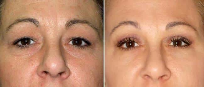Brow and Forehead Lift Before & After Gallery - Patient 38564730 - Image 1