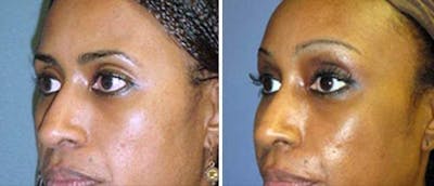 Brow and Forehead Lift Before & After Gallery - Patient 38564731 - Image 1