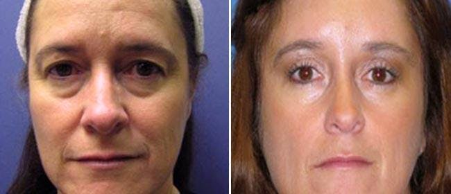 Brow and Forehead Lift Before & After Gallery - Patient 38564732 - Image 1