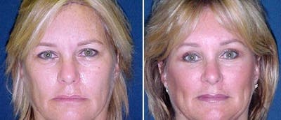 Brow and Forehead Lift Before & After Gallery - Patient 38564733 - Image 1