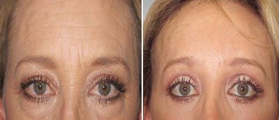 Brow and Forehead Lift Before & After Gallery - Patient 38564734 - Image 1