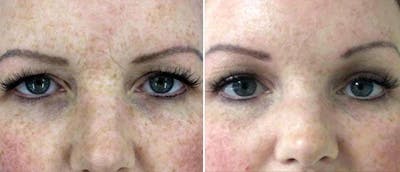 Brow and Forehead Lift Before & After Gallery - Patient 38564735 - Image 1
