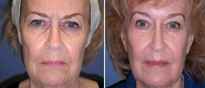 Brow and Forehead Lift Before & After Gallery - Patient 38564736 - Image 1