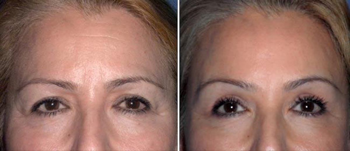 Brow Lift Before & After Gallery - Patient 38564737 - Image 1