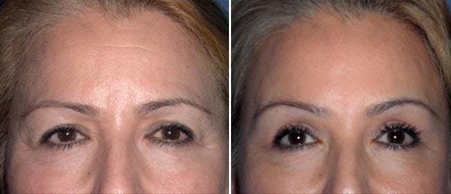 Brow and Forehead Lift Before & After Gallery - Patient 38564737 - Image 1
