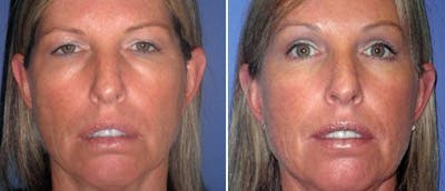 Brow Lift Before & After Gallery - Patient 38564738 - Image 1