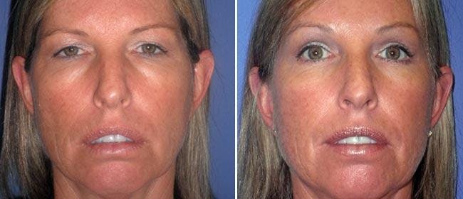 Brow and Forehead Lift Before & After Gallery - Patient 38564738 - Image 1