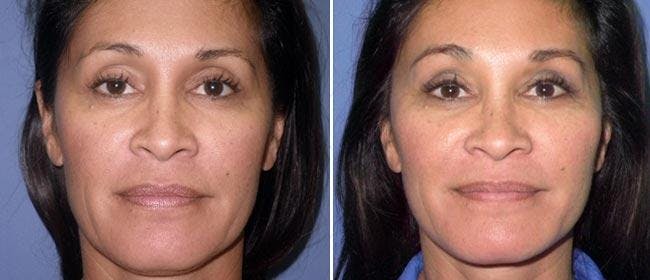 Brow and Forehead Lift Before & After Gallery - Patient 38564739 - Image 1