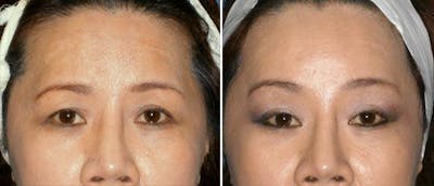 Brow Lift Before & After Gallery - Patient 38564740 - Image 1
