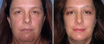 Brow Lift Before & After Gallery - Patient 38564741 - Image 1