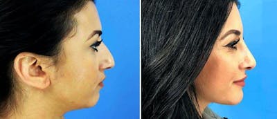 Chin and Cheek Implant Before & After Gallery - Patient 38564858 - Image 1