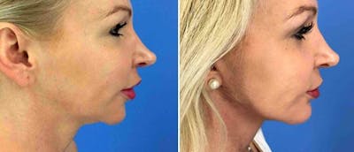 Chin and Cheek Implant Before & After Gallery - Patient 38564859 - Image 1