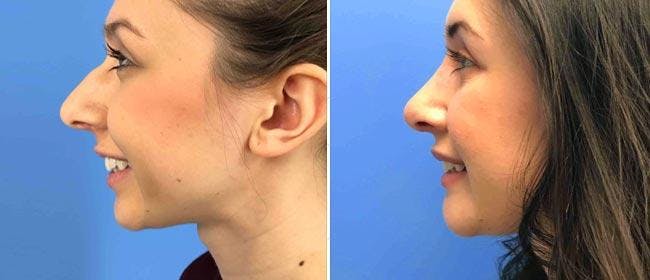 Chin and Cheek Implant Before & After Gallery - Patient 38564860 - Image 1