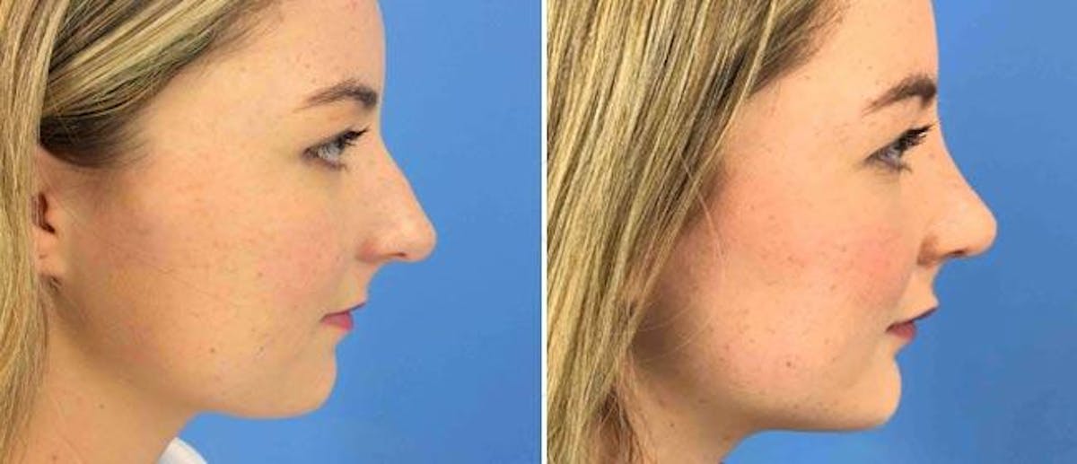 Chin and Cheek Implant Before & After Gallery - Patient 38564861 - Image 1