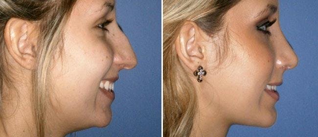 Chin and Cheek Implant Before & After Gallery - Patient 38564862 - Image 1