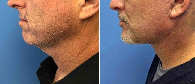 Chin and Cheek Implant Before & After Gallery - Patient 38564863 - Image 1