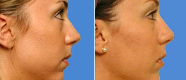 Chin and Cheek Implant Before & After Gallery - Patient 38564864 - Image 1
