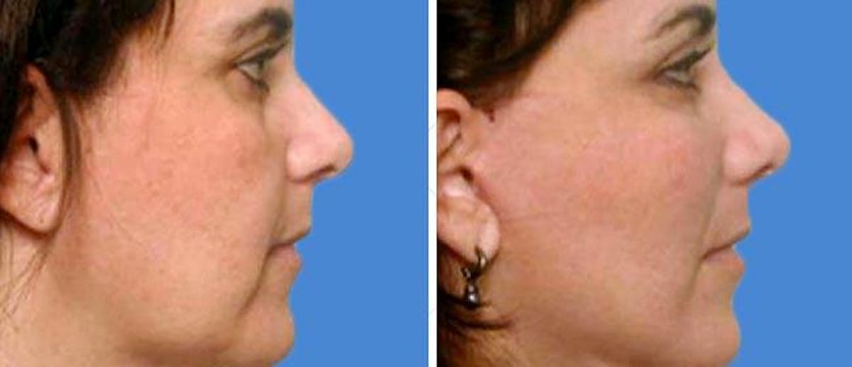 Chin and Cheek Implant Before & After Gallery - Patient 38564865 - Image 1