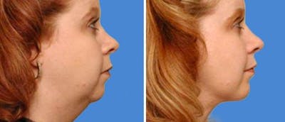 Chin and Cheek Implant Before & After Gallery - Patient 38564869 - Image 1
