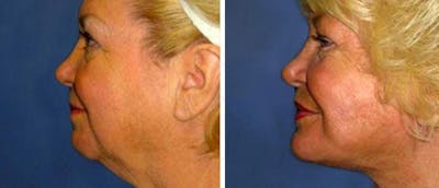 Chin and Cheek Implant Before & After Gallery - Patient 38564870 - Image 1