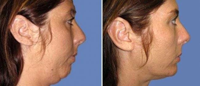Chin and Cheek Implant Before & After Gallery - Patient 38564871 - Image 1