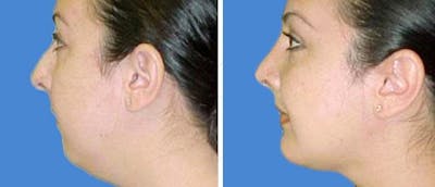 Chin and Cheek Implant Before & After Gallery - Patient 38564873 - Image 1