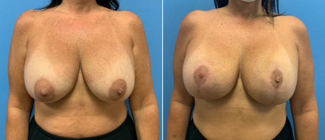 Breast Lift (Mastopexy) Before & After Gallery - Patient 38564914 - Image 1