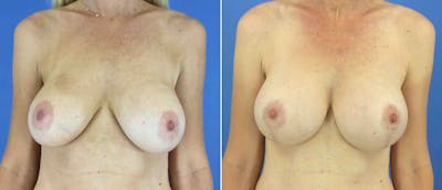 Breast Lift (Mastopexy) Before & After Gallery - Patient 38564916 - Image 1