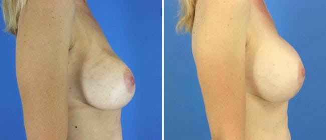 Breast Lift (Mastopexy) Before & After Gallery - Patient 38564916 - Image 2