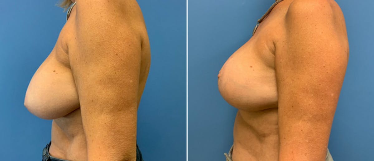 Breast Lift (Mastopexy) Before & After Gallery - Patient 38564920 - Image 2