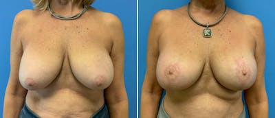 Breast Lift (Mastopexy) Before & After Gallery - Patient 38564920 - Image 1