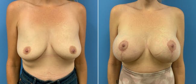 Breast Lift (Mastopexy) Before & After Gallery - Patient 38564923 - Image 1