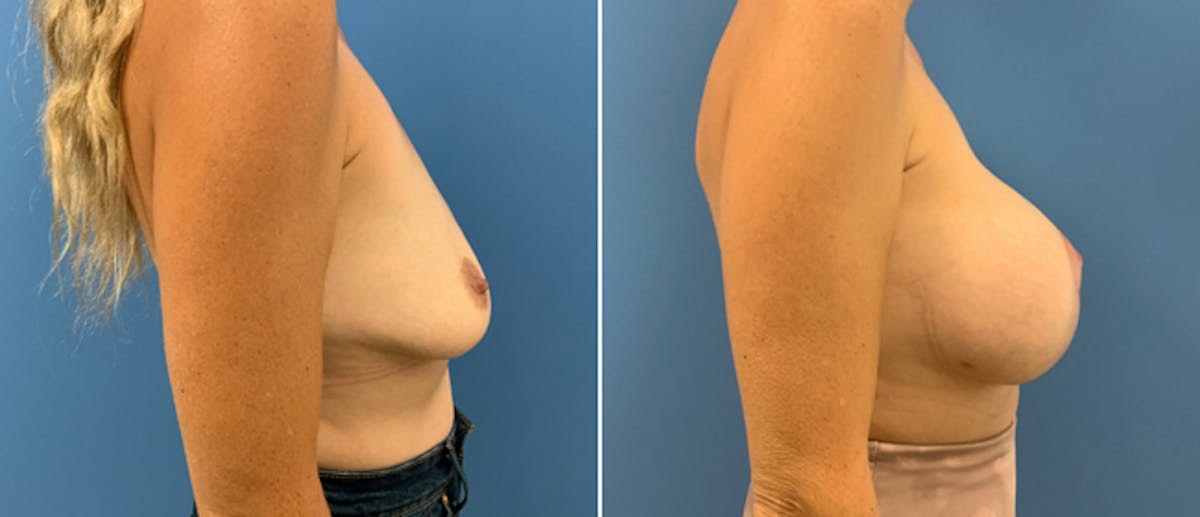 Breast Lift (Mastopexy) Before & After Gallery - Patient 38564923 - Image 2