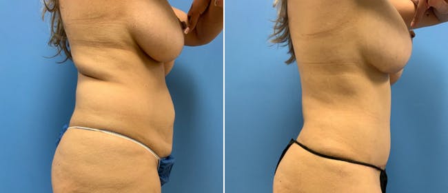 Breast Lift (Mastopexy) Before & After Gallery - Patient 38564927 - Image 2