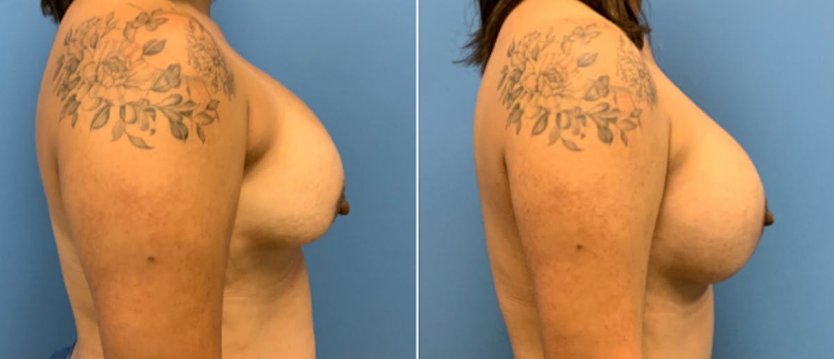 Breast Lift (Mastopexy) Before & After Gallery - Patient 38564931 - Image 2
