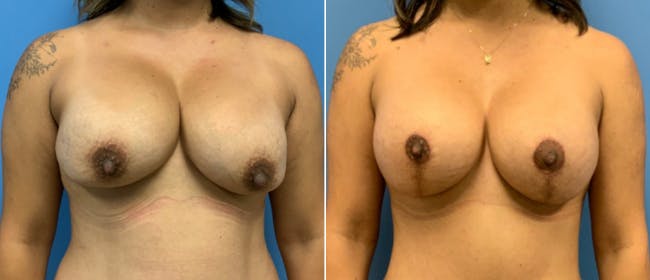 Breast Lift (Mastopexy) Before & After Gallery - Patient 38564931 - Image 1