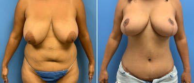 Breast Lift (Mastopexy) Before & After Gallery - Patient 38564940 - Image 1