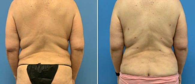 Breast Lift (Mastopexy) Before & After Gallery - Patient 38564947 - Image 3