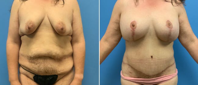 Breast Lift (Mastopexy) Before & After Gallery - Patient 38564947 - Image 1