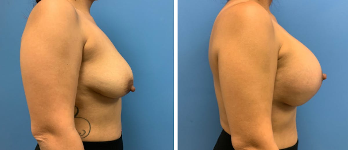 Breast Lift (Mastopexy) Before & After Gallery - Patient 38564952 - Image 2