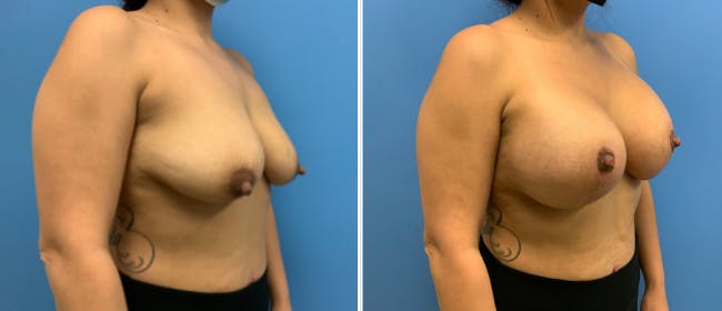 Breast Lift (Mastopexy) Before & After Gallery - Patient 38564952 - Image 3