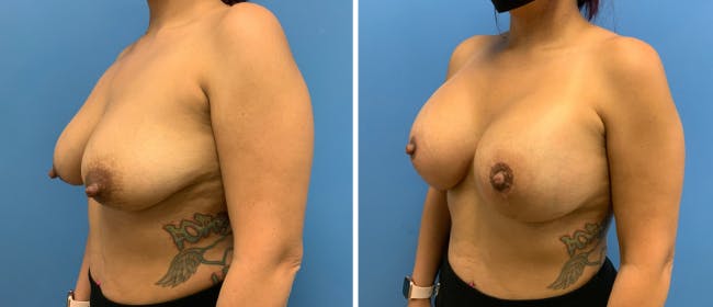 Breast Lift (Mastopexy) Before & After Gallery - Patient 38564952 - Image 4
