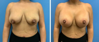 Breast Lift (Mastopexy) Before & After Gallery - Patient 38564952 - Image 1